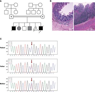 A Novel Homozygous TTC7A Missense Mutation Results in Familial Multiple Intestinal Atresia and Combined Immunodeficiency